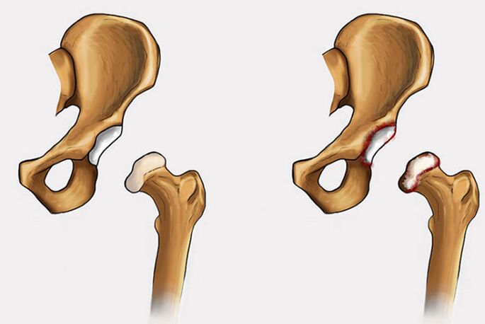 degeneraciniai pokyčiai ir skausmas klubo sąnaryje