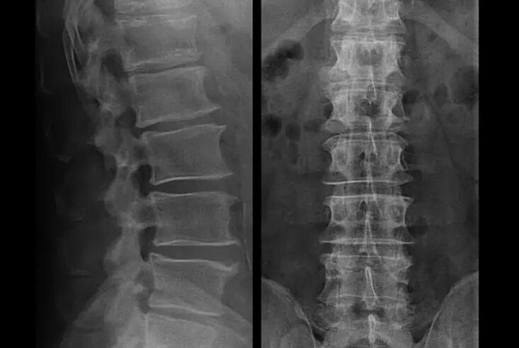 Osteochondrozė rentgeno spinduliuose