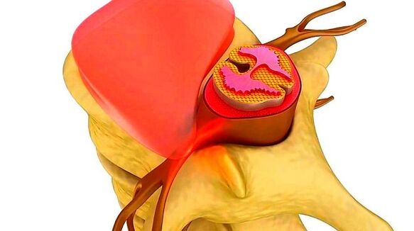 Krūtinės ląstos stuburo osteochondrozė ligos esmė