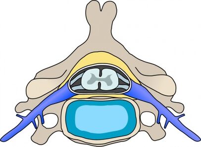 Protebijus slanksteliuose su gimdos kaklelio osteochondroze